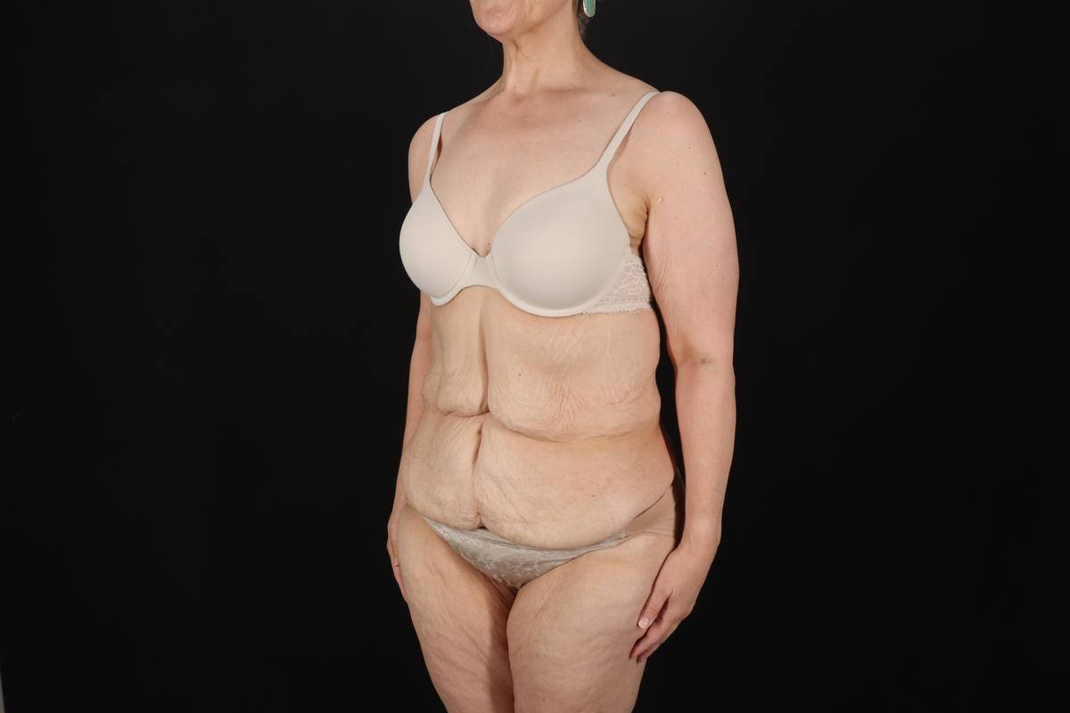 Fleur De Lis Circumferential Body Lift Before & After Patient #9328