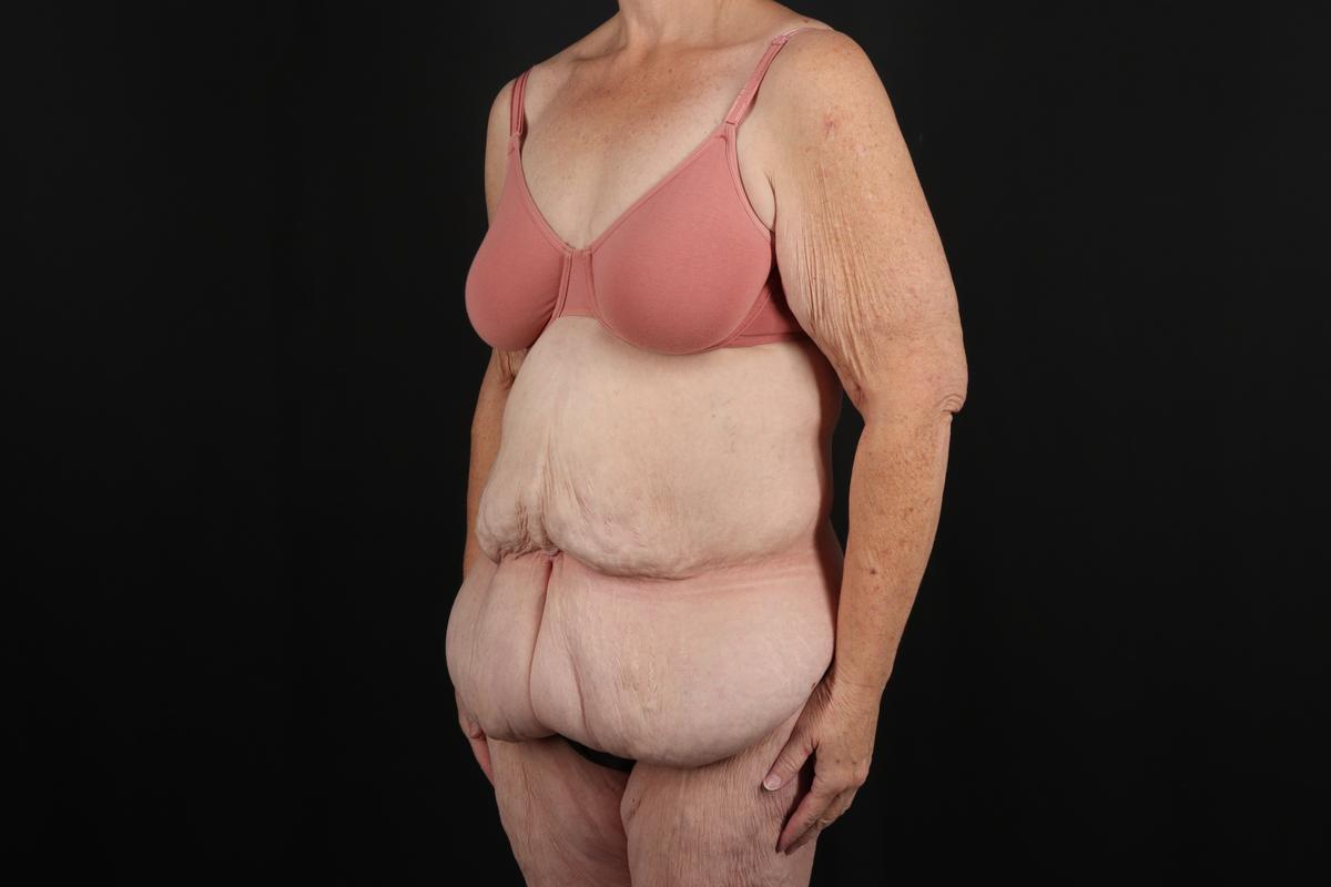 Fleur De Lis Circumferential Body Lift Before & After Patient #9285