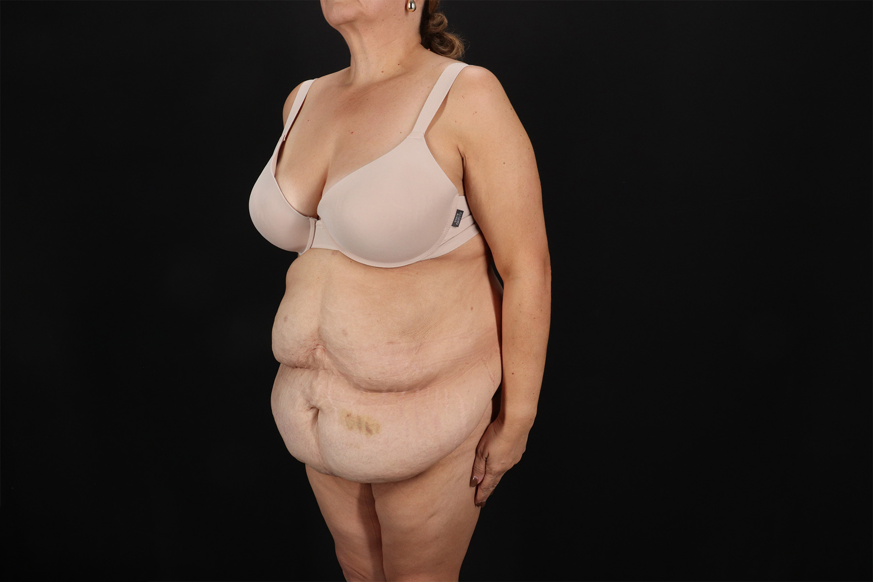 Fleur De Lis Tummy Tuck Before & After Patient #9510
