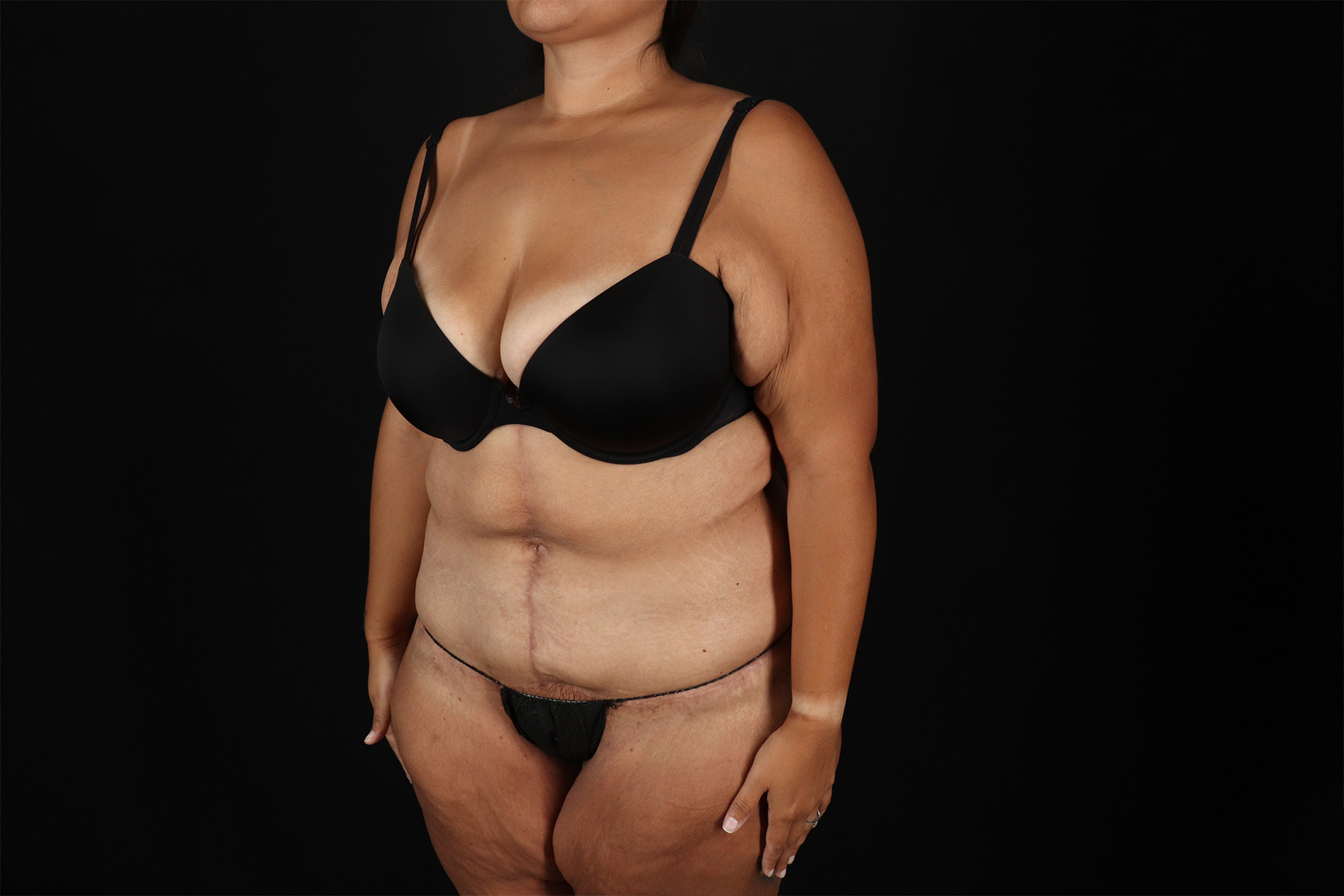 Fleur De Lis Tummy Tuck Before & After Patient #9508