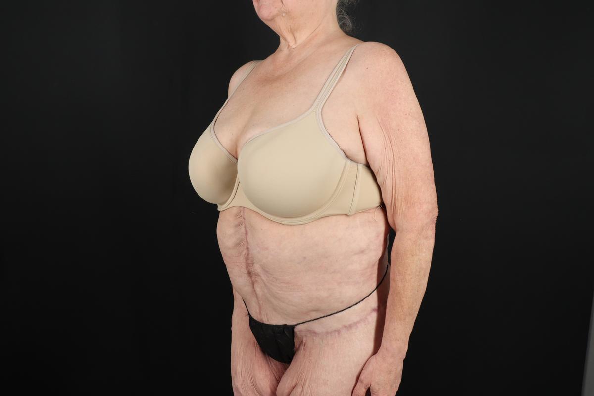 Fleur De Lis Circumferential Body Lift Before & After Patient #9286