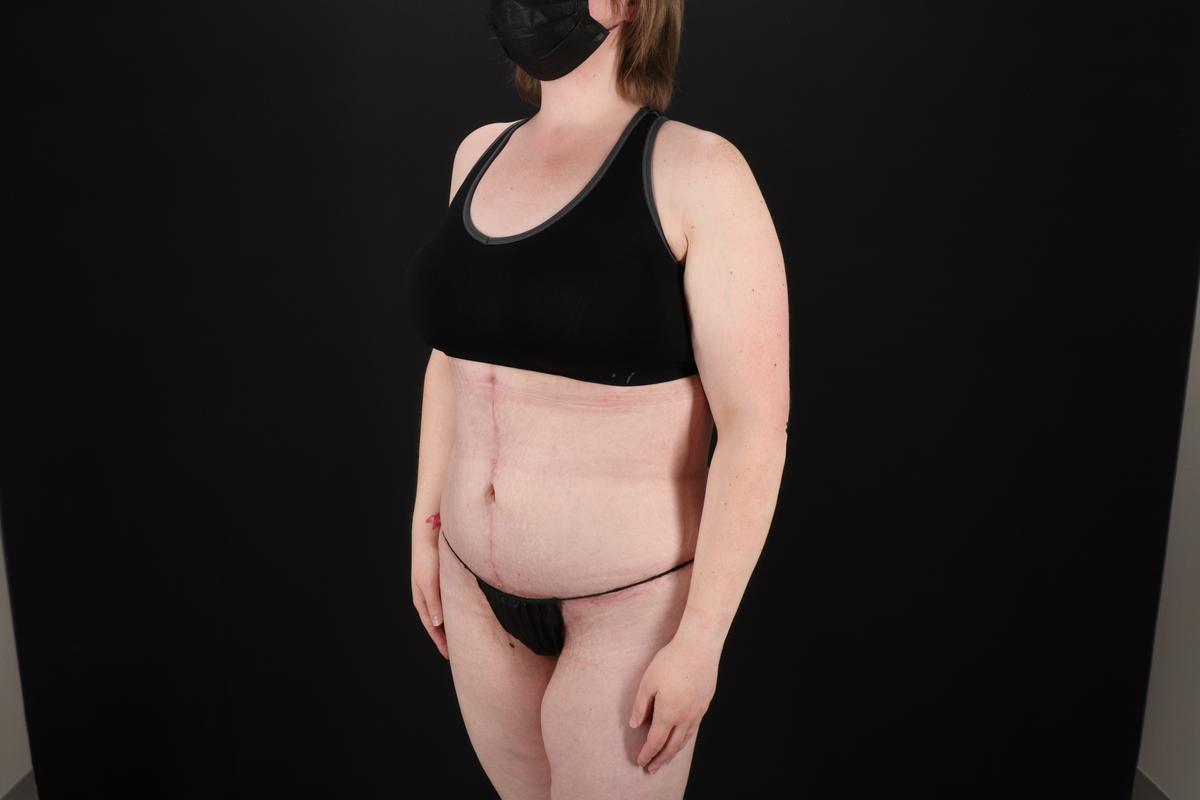 Fleur De Lis Tummy Tuck Before & After Patient #9506