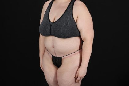 Fleur De Lis Circumferential Body Lift Before & After Patient #9284