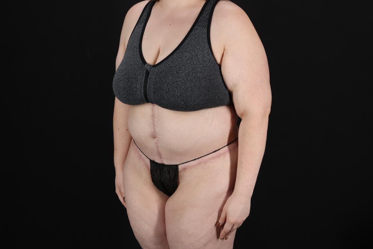Fleur De Lis Circumferential Body Lift Before & After Patient #9284