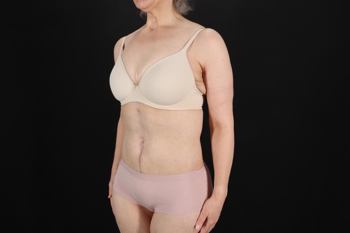 Fleur De Lis Circumferential Body Lift Before & After Patient #9328