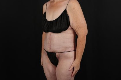 Fleur De Lis Circumferential Body Lift Before & After Patient #9285