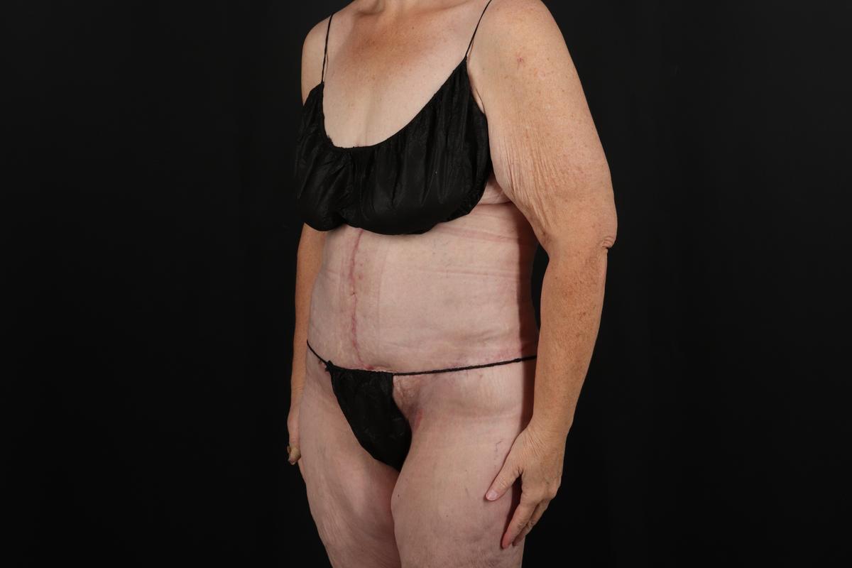 Fleur De Lis Circumferential Body Lift Before & After Patient #9285