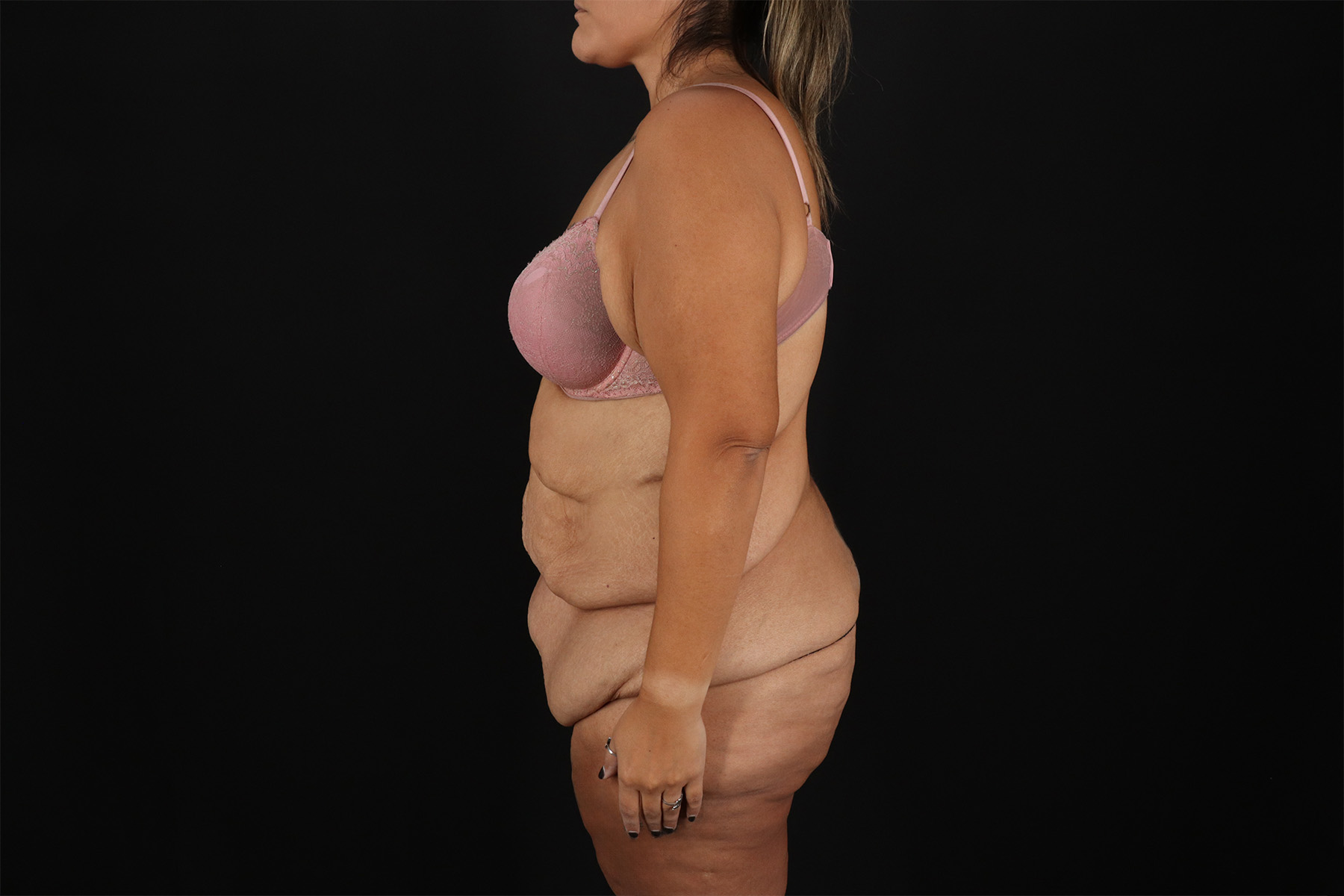 Fleur De Lis Tummy Tuck Before & After Patient #9508