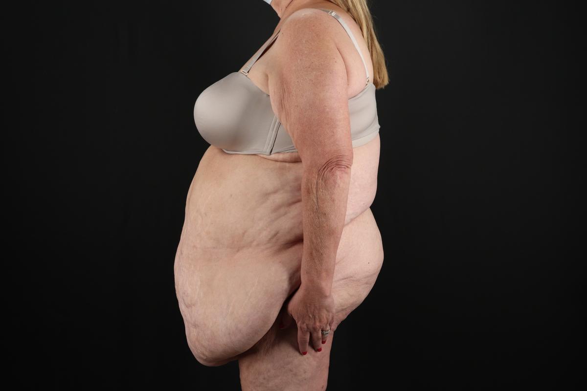 Fleur De Lis Circumferential Body Lift Before & After Patient #9286