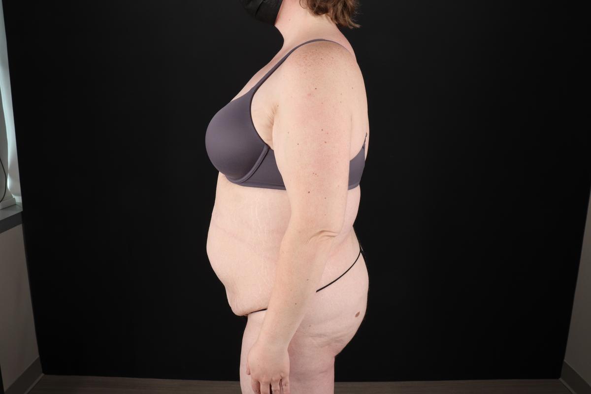 Fleur De Lis Tummy Tuck Before & After Patient #9506