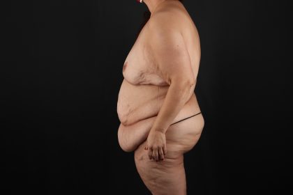 Fleur De Lis Circumferential Body Lift Before & After Patient #9278