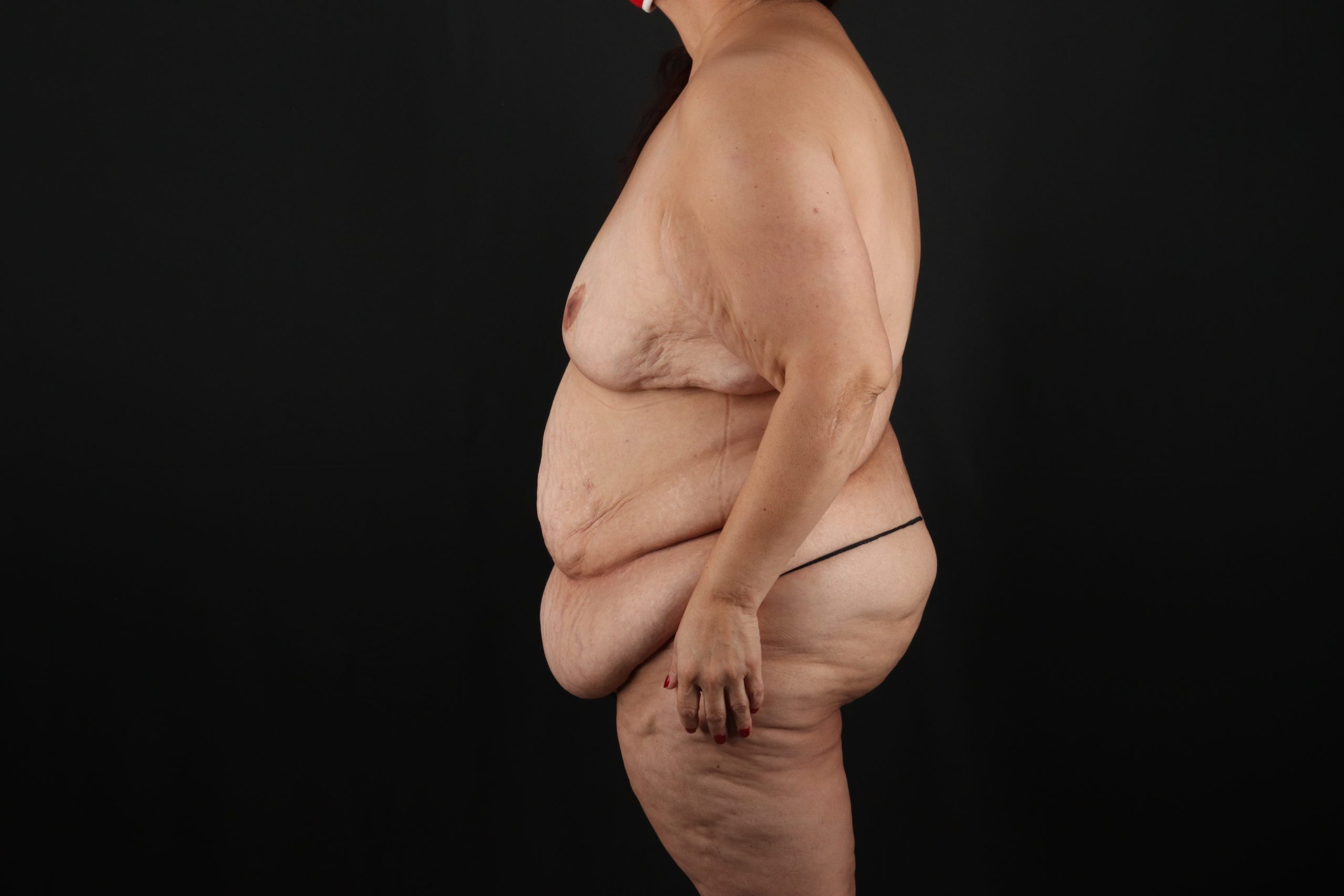 Fleur De Lis Circumferential Body Lift Before & After Patient #9278