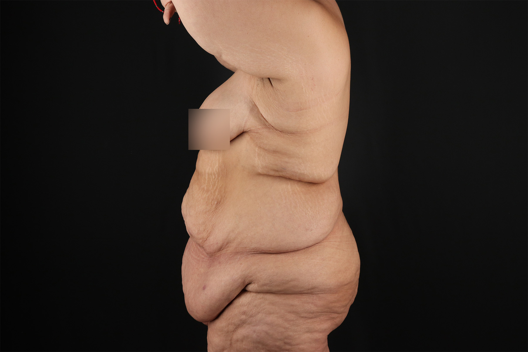 Fleur De Lis Tummy Tuck Before & After Patient #9509