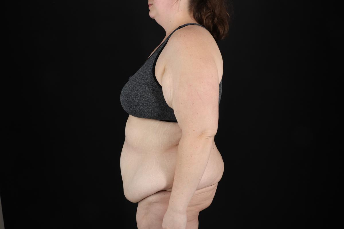 Fleur De Lis Circumferential Body Lift Before & After Patient #9284