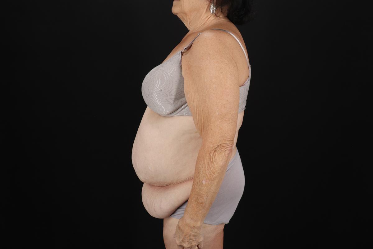 Fleur De Lis Tummy Tuck Before & After Patient #9507