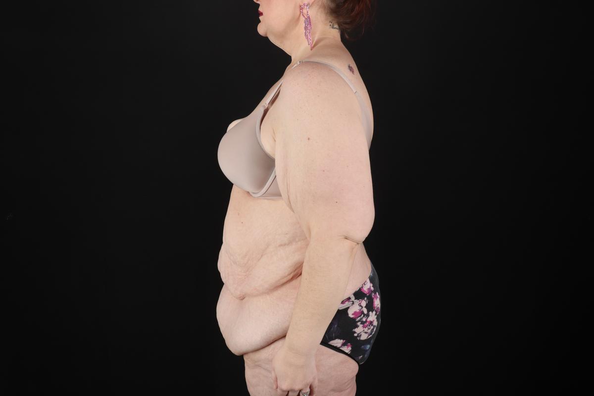 Fleur De Lis Circumferential Body Lift Before & After Patient #9283
