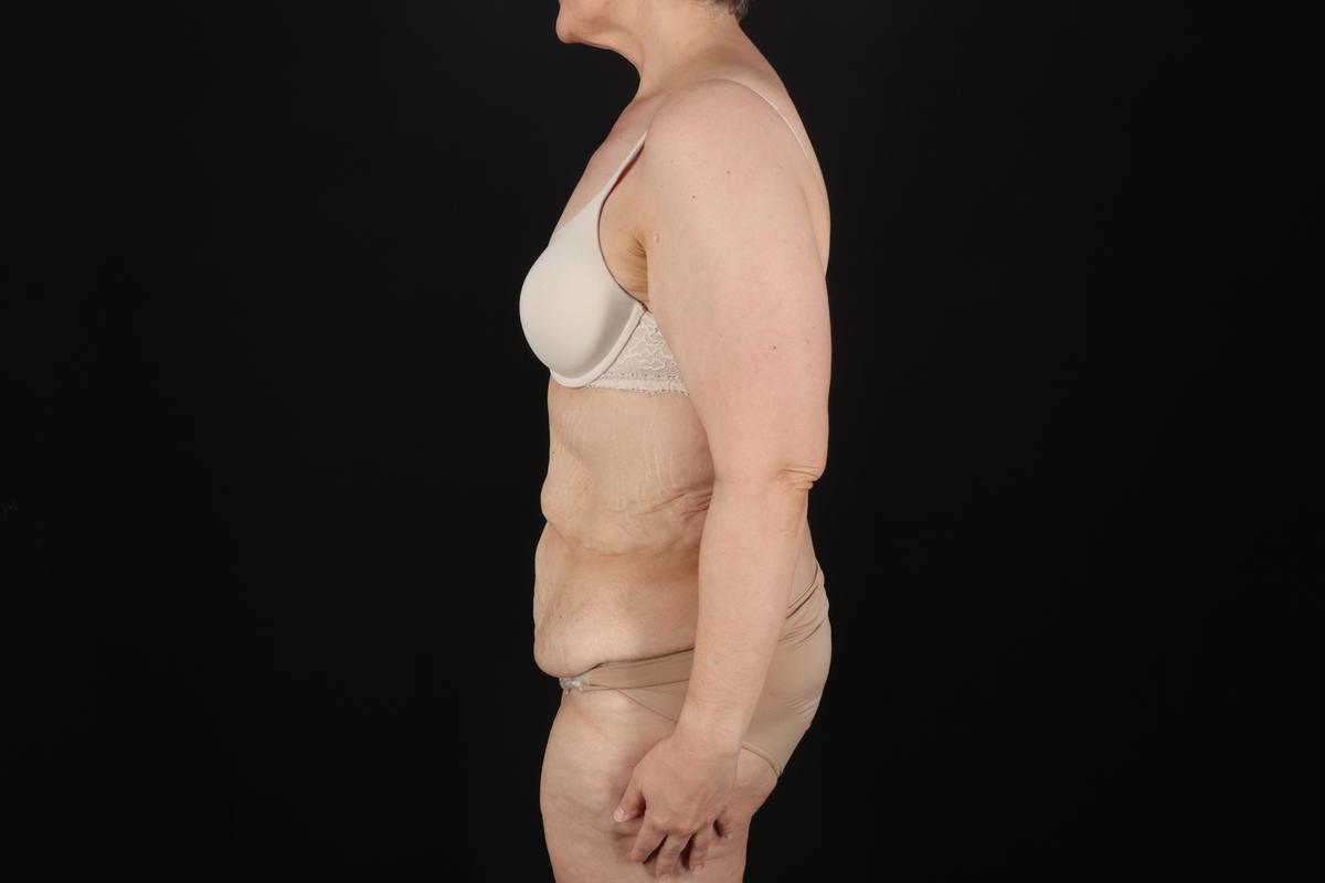 Fleur De Lis Circumferential Body Lift Before & After Patient #9328