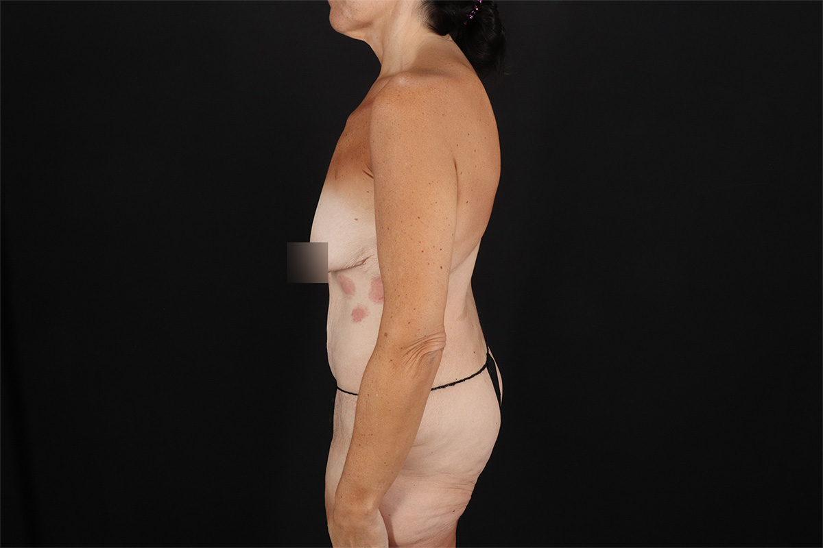 Fleur De Lis Circumferential Body Lift Before & After Patient #9279