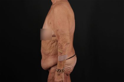 Fleur De Lis Circumferential Body Lift Before & After Patient #9281