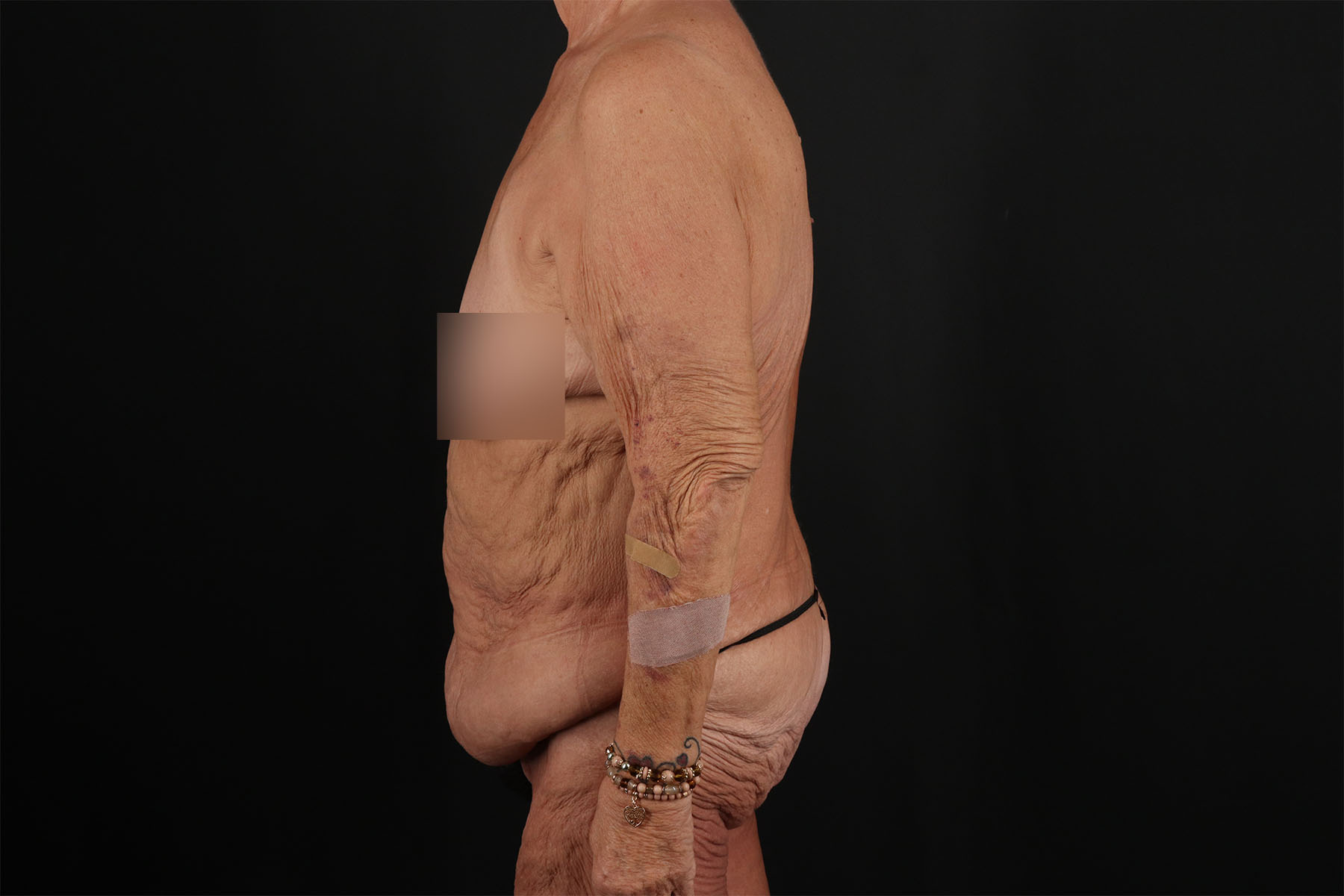 Fleur De Lis Circumferential Body Lift Before & After Patient #9281