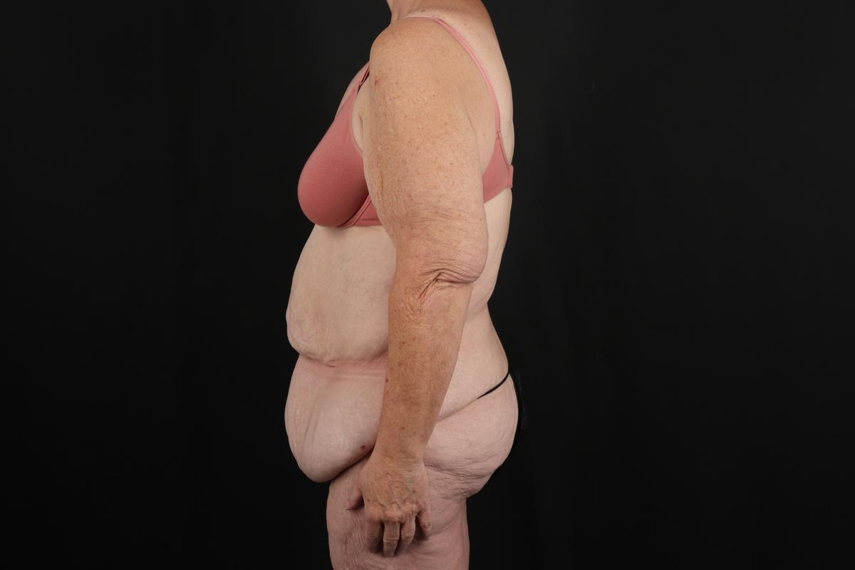 Fleur De Lis Circumferential Body Lift Before & After Patient #9285