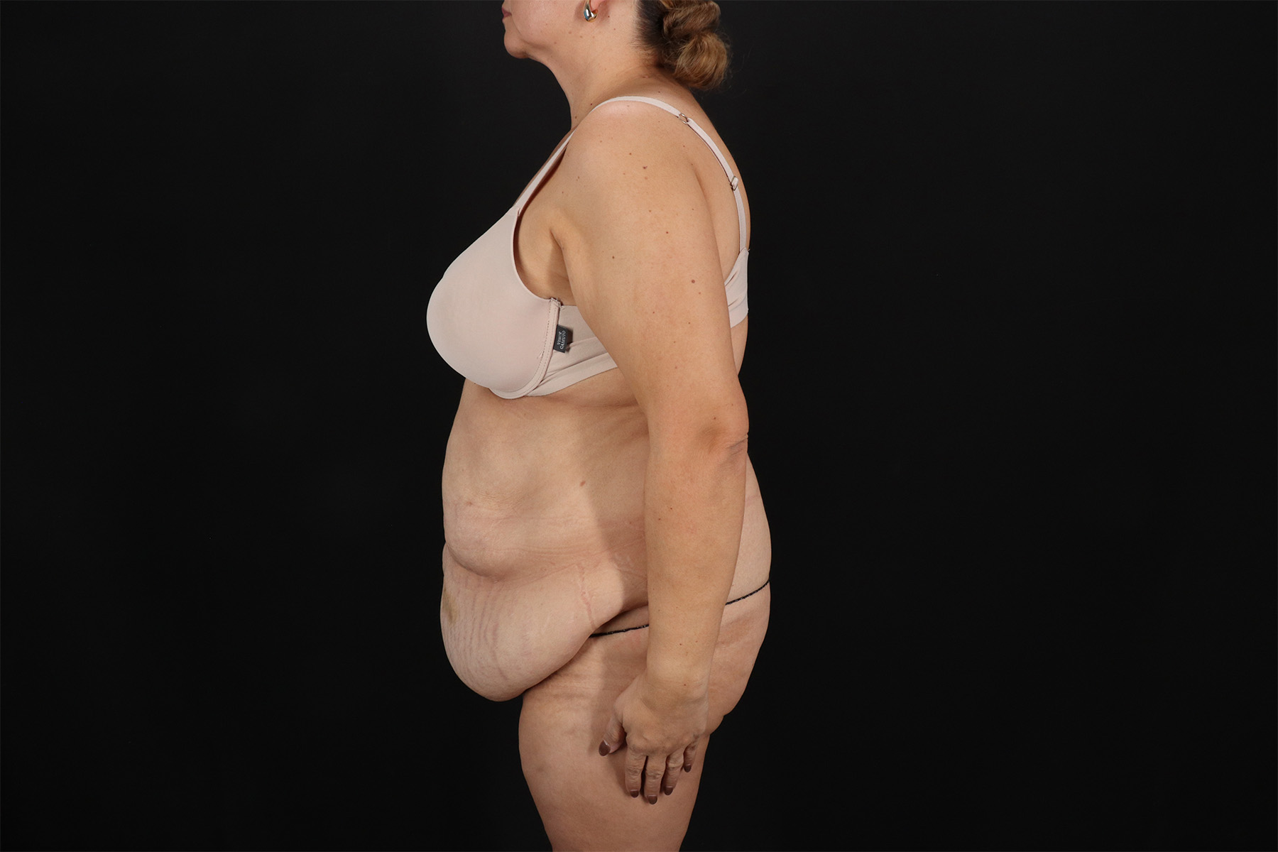 Fleur De Lis Tummy Tuck Before & After Patient #9510