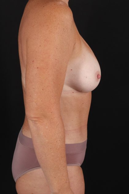 All Me Augmentation Before & After Patient #9695