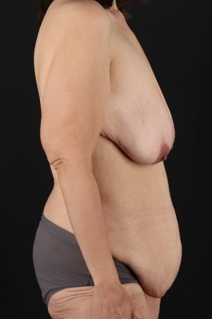 All Me Augmentation Before & After Patient #9667