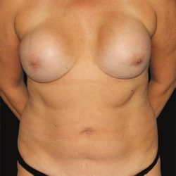 All Me Augmentation Before & After Patient #9618