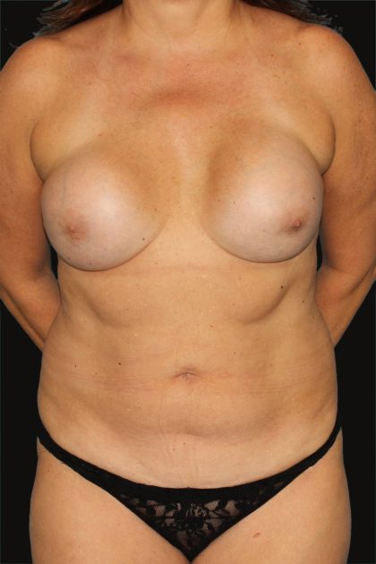 All Me Augmentation Before & After Patient #9618