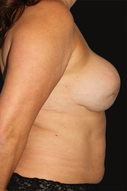 All Me Augmentation Before & After Patient #9618