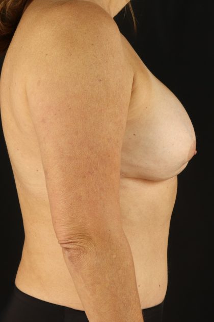 All Me Augmentation Before & After Patient #9618