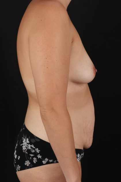 All Me Augmentation Before & After Patient #9702