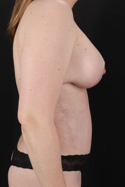All Me Augmentation Before & After Patient #9625