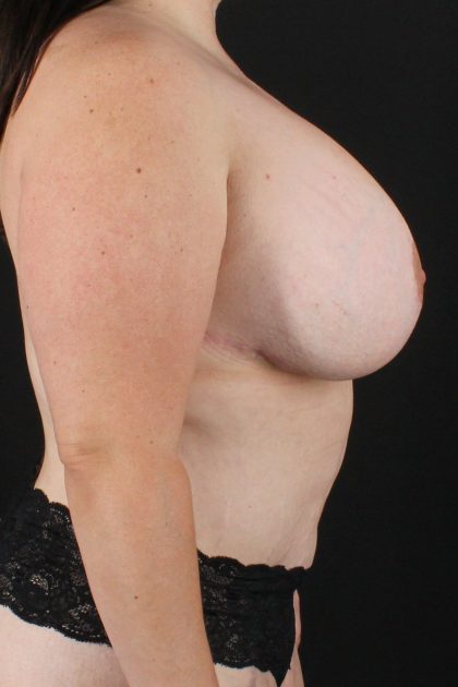 All Me Augmentation Before & After Patient #9681