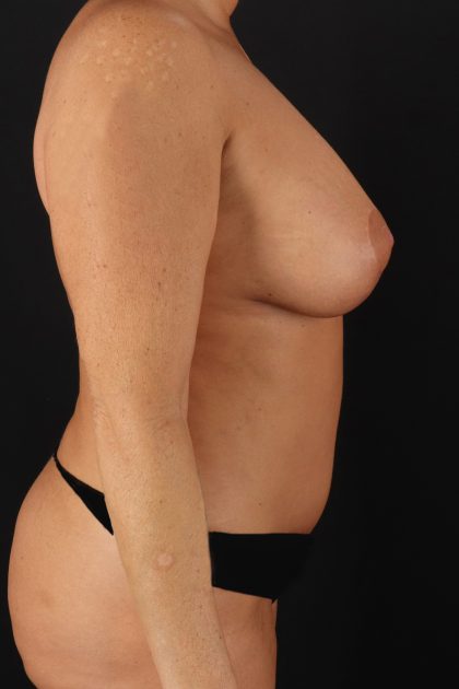 All Me Augmentation Before & After Patient #9674