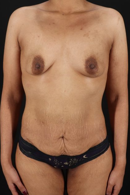 All Me Augmentation Before & After Patient #9646