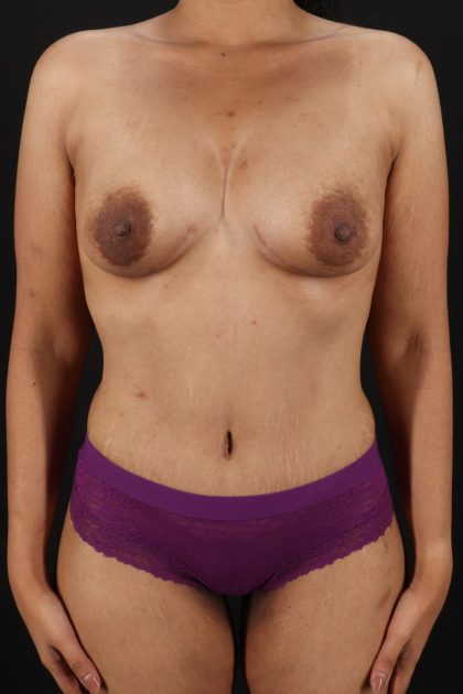 All Me Augmentation Before & After Patient #9646