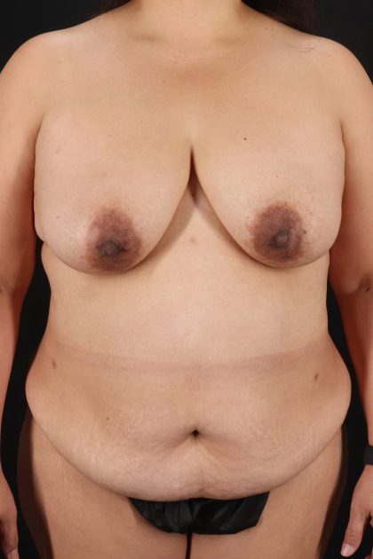 All Me Augmentation Before & After Patient #9653