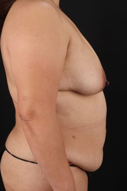 All Me Augmentation Before & After Patient #9653