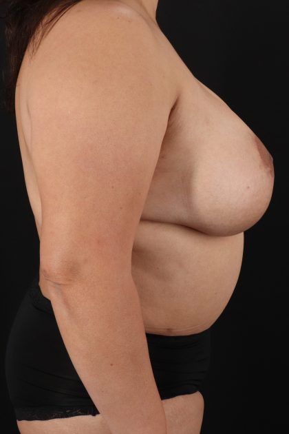 All Me Augmentation Before & After Patient #9653