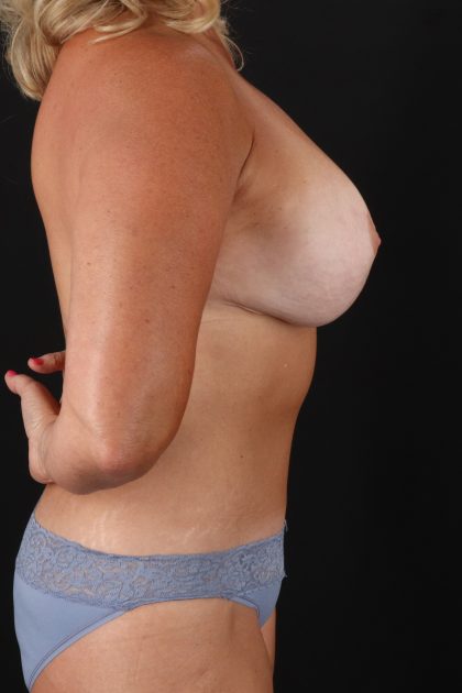 All Me Augmentation Before & After Patient #9632