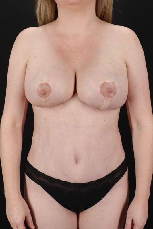 All Me Augmentation Before & After Patient #9625