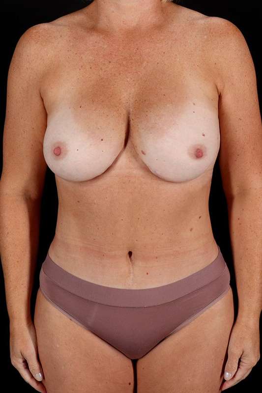 All Me Augmentation Before & After Patient #9695