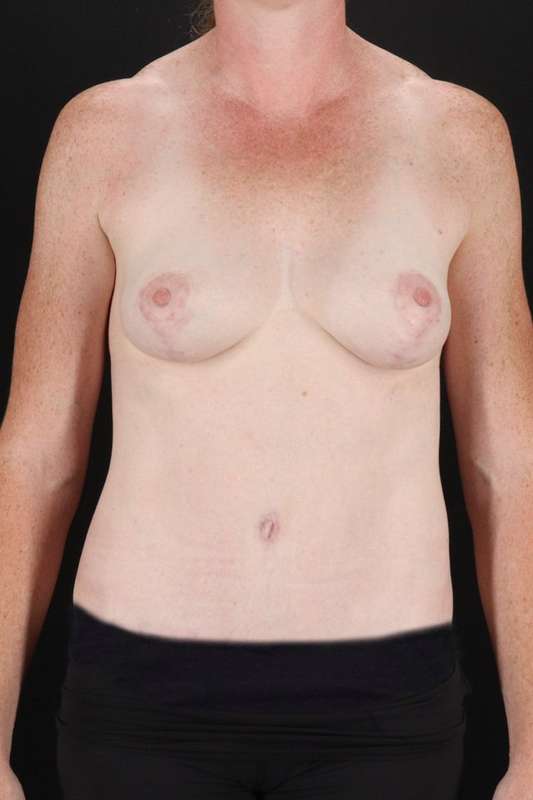 All Me Augmentation Before & After Patient #9639