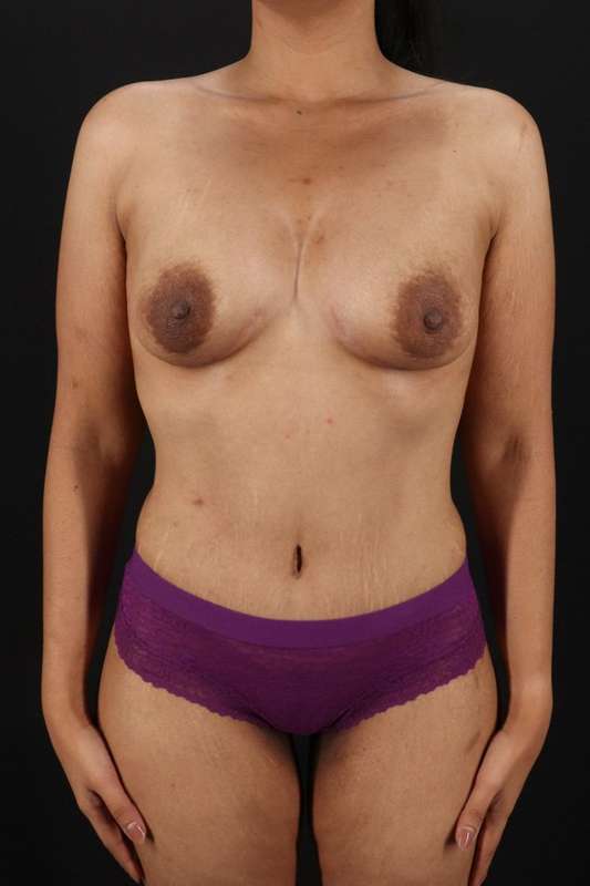 All Me Augmentation Before & After Patient #9646