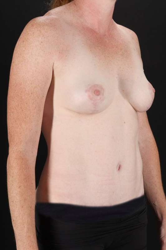 All Me Augmentation Before & After Patient #9639