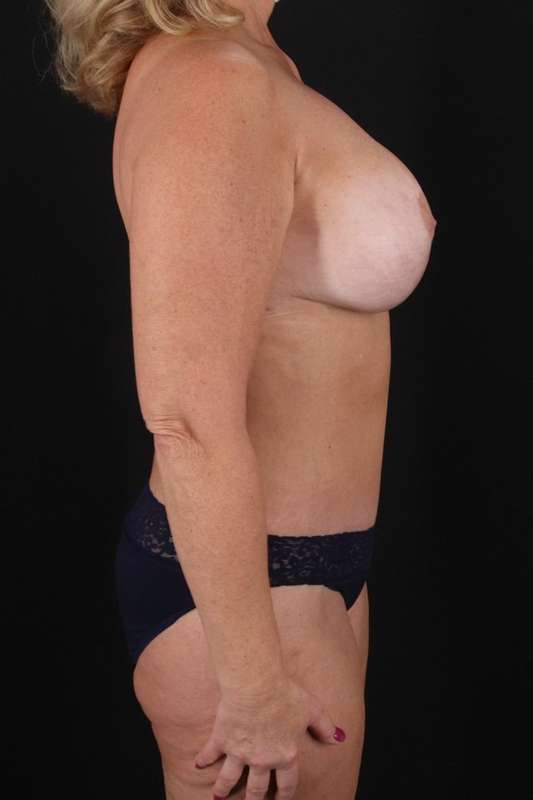 All Me Augmentation Before & After Patient #9632