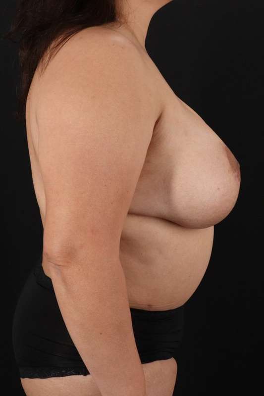 All Me Augmentation Before & After Patient #9653