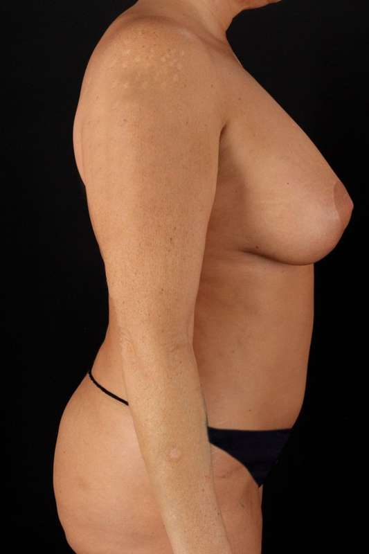 All Me Augmentation Before & After Patient #9674